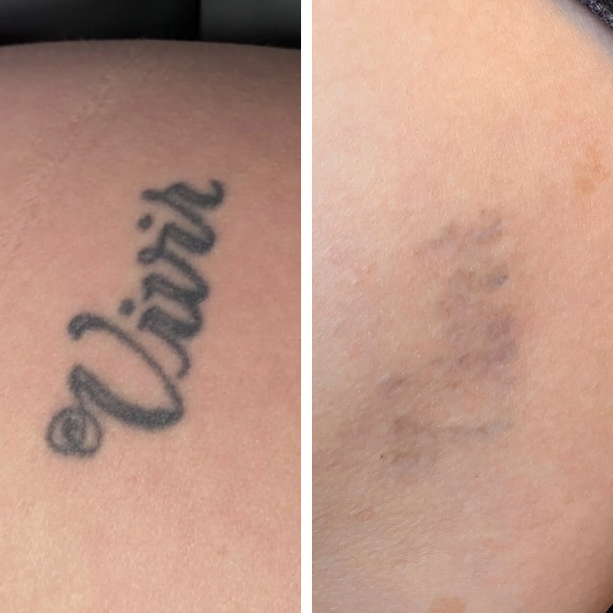 salt and ice burn on skin