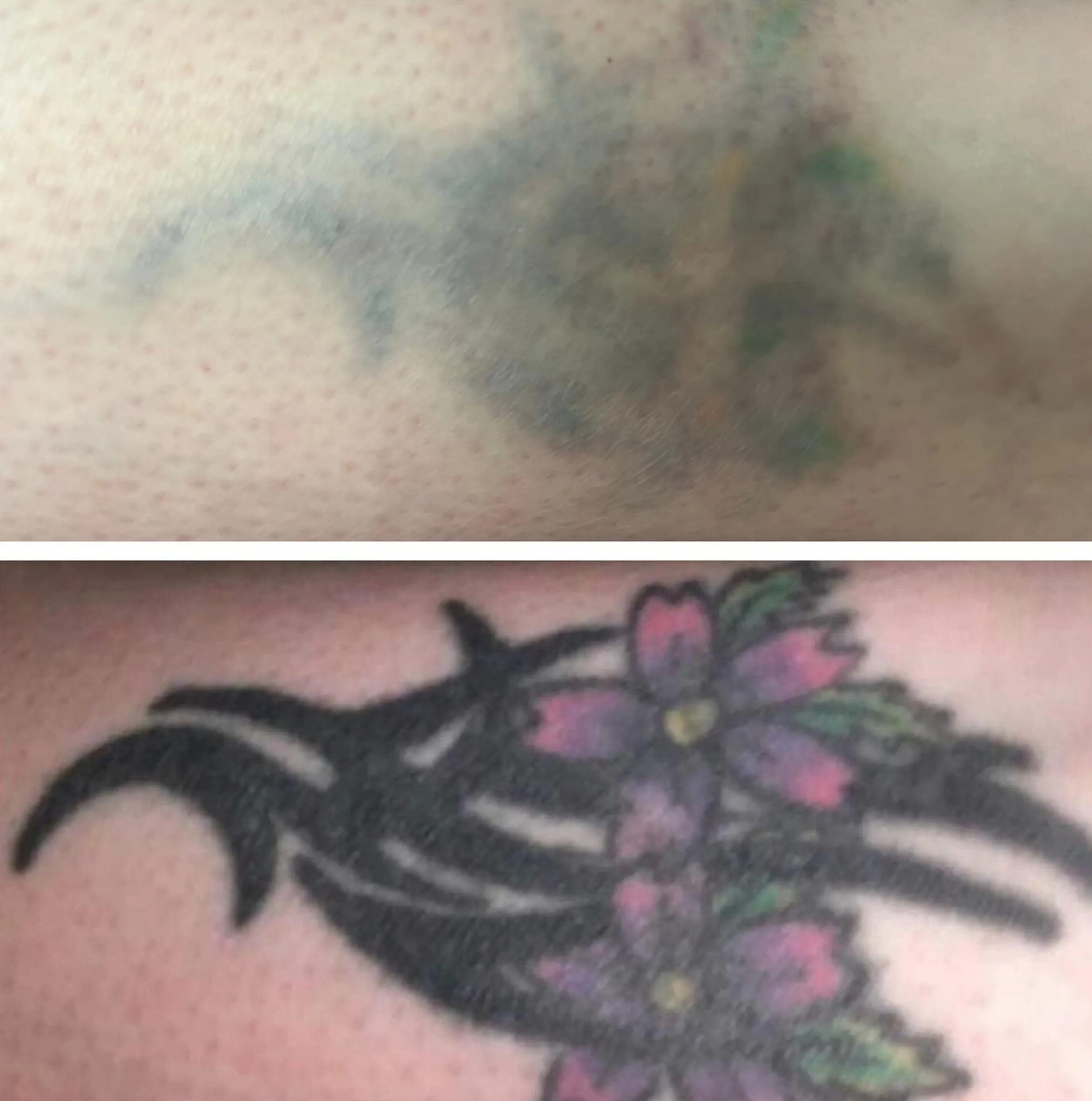 eyebrow tattoo removal