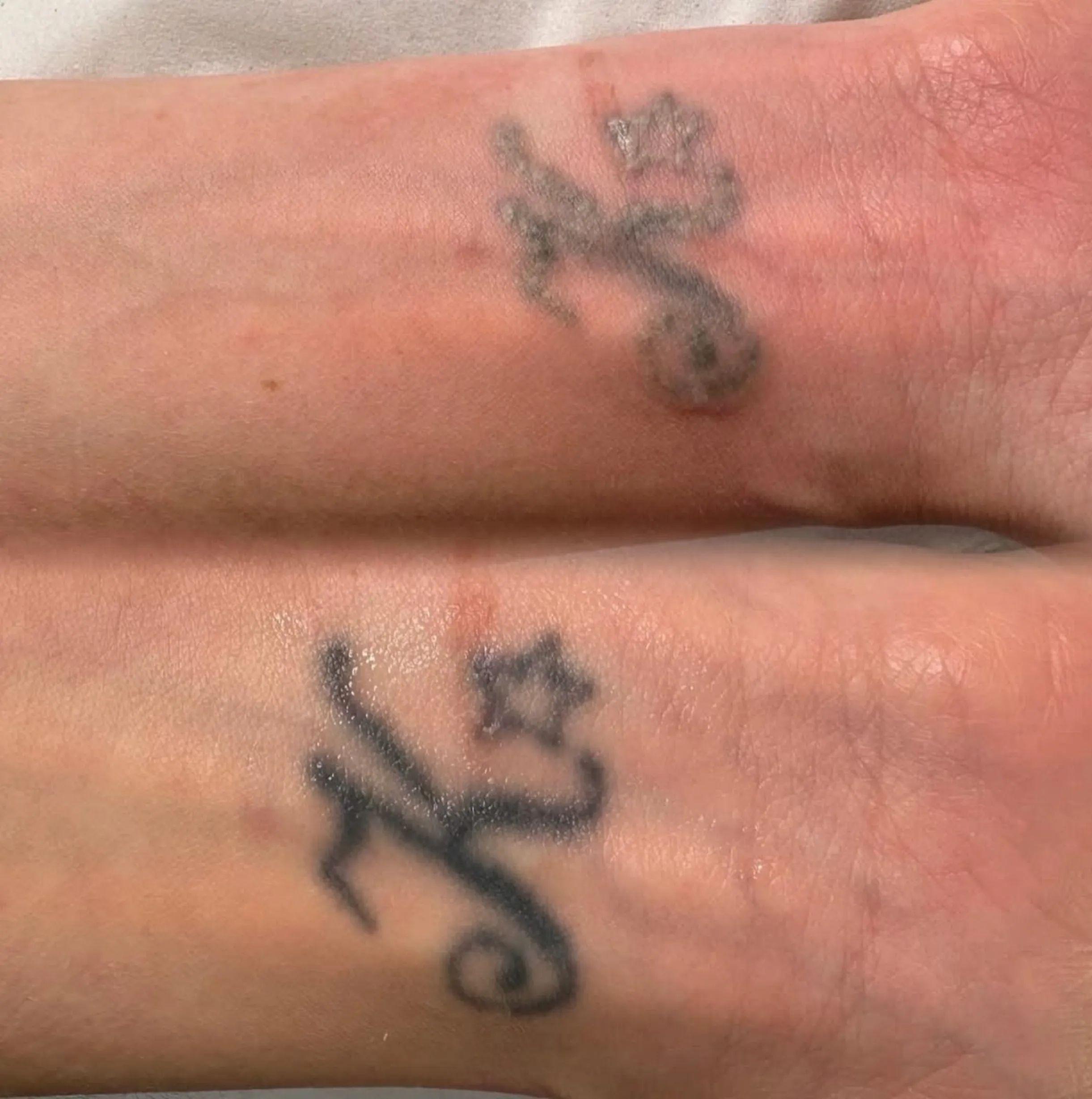 laser tattoo removal Brisbane