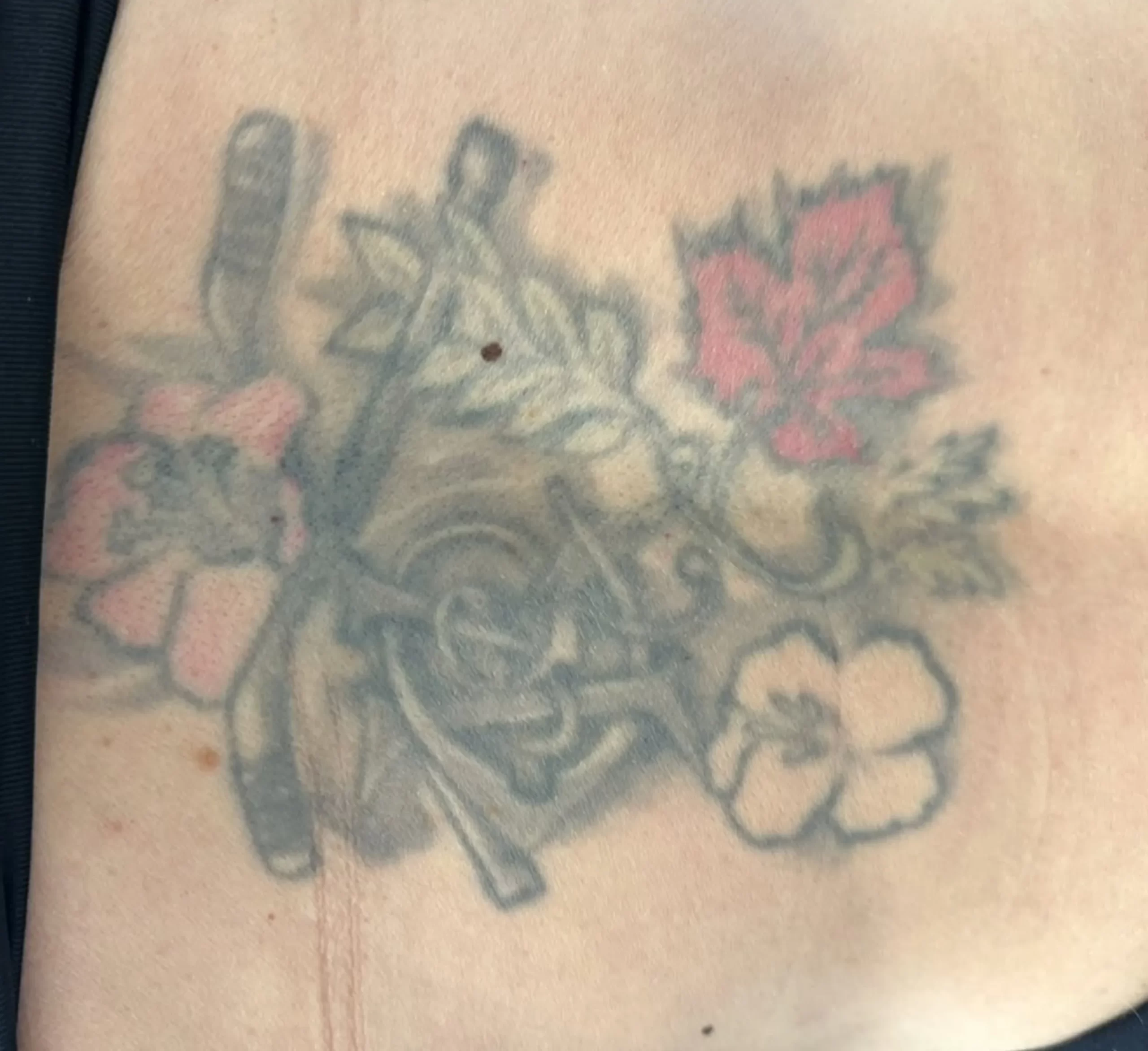 dangers of DIY tattoo removal
