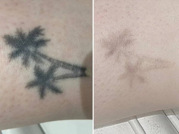 salt and ice tattoo removal