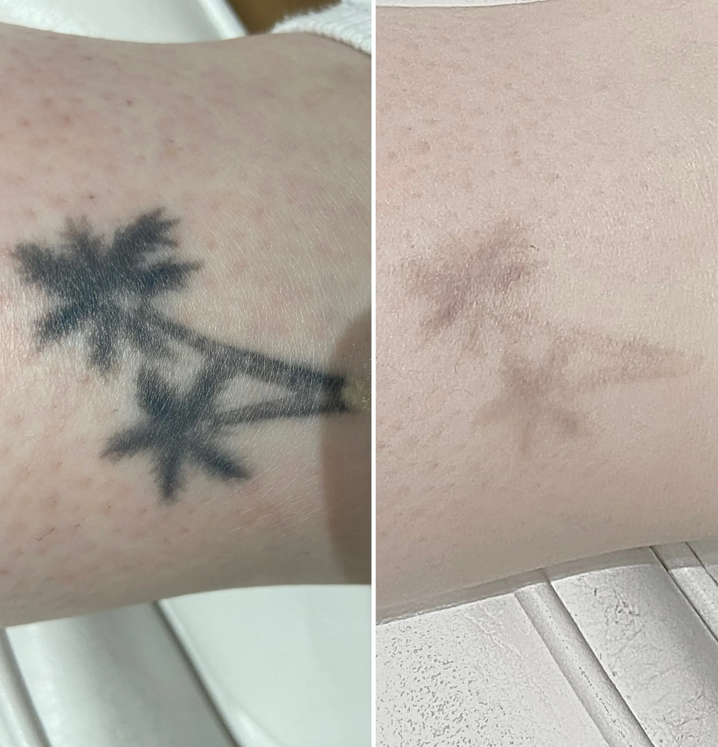 salt and ice tattoo removal